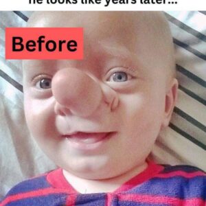 This baby’s nickname was Pinocchio and check out what he looks like years later…