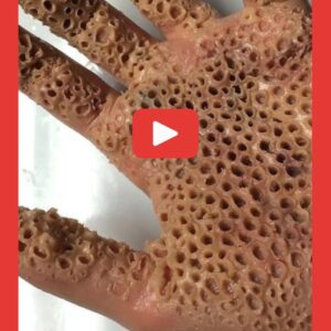 Hand Riddled With Tiny Holes Reveals A Mysterious Phobia