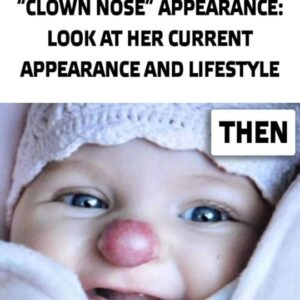 Nine years ago, a young girl was born with a distinctive “clown nose” appearance: Look at her current appearance and lifestyle