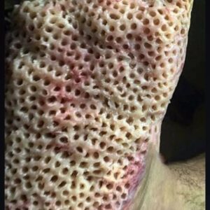 TRYPOPHOBIA!!